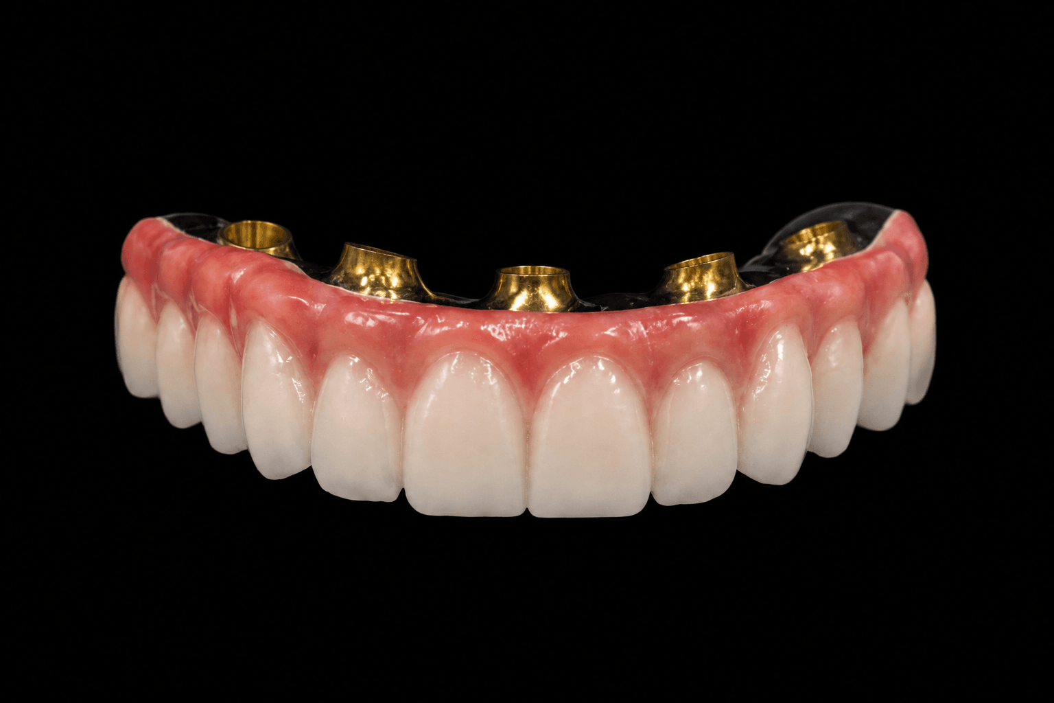 Front view of John's zirconia full-arch prosthesis with titanium framework