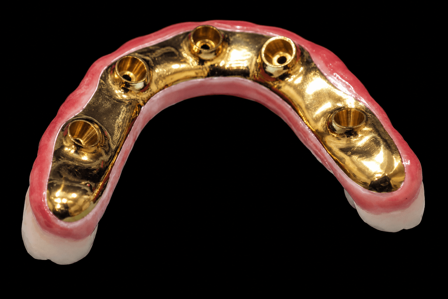 Underside of John's full-arch prosthesis showing five implant connections in the titanium framework