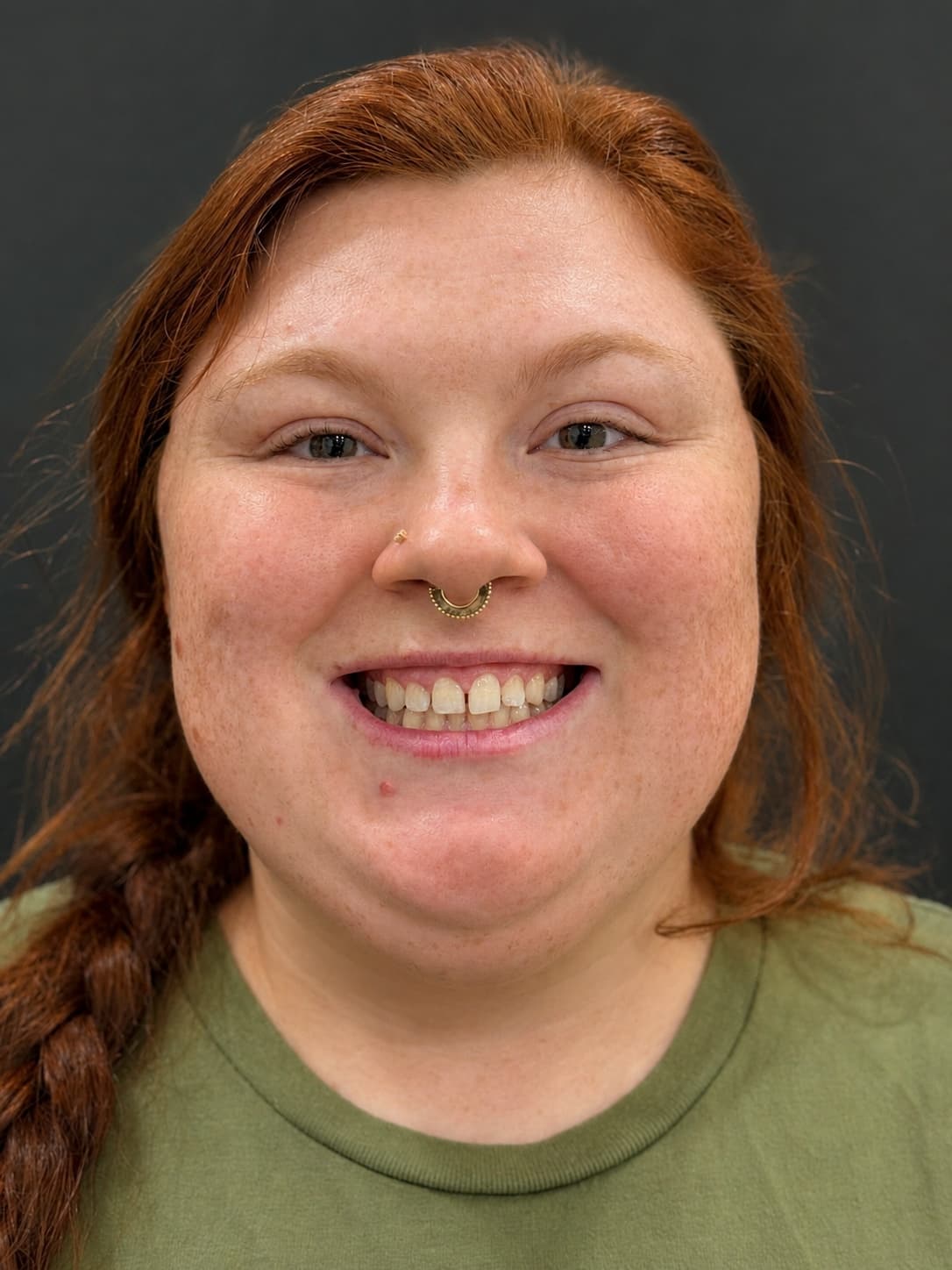 Hazel before four conservative veneers