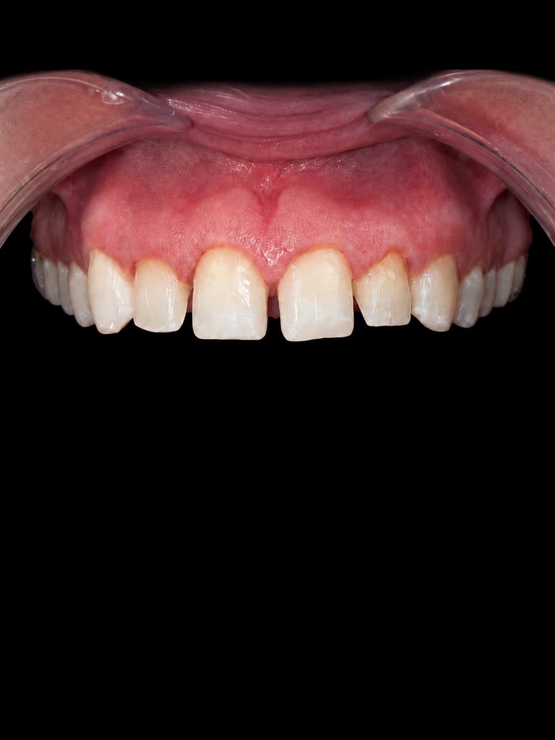Hazel's four front teeth after conservative preparation for veneers