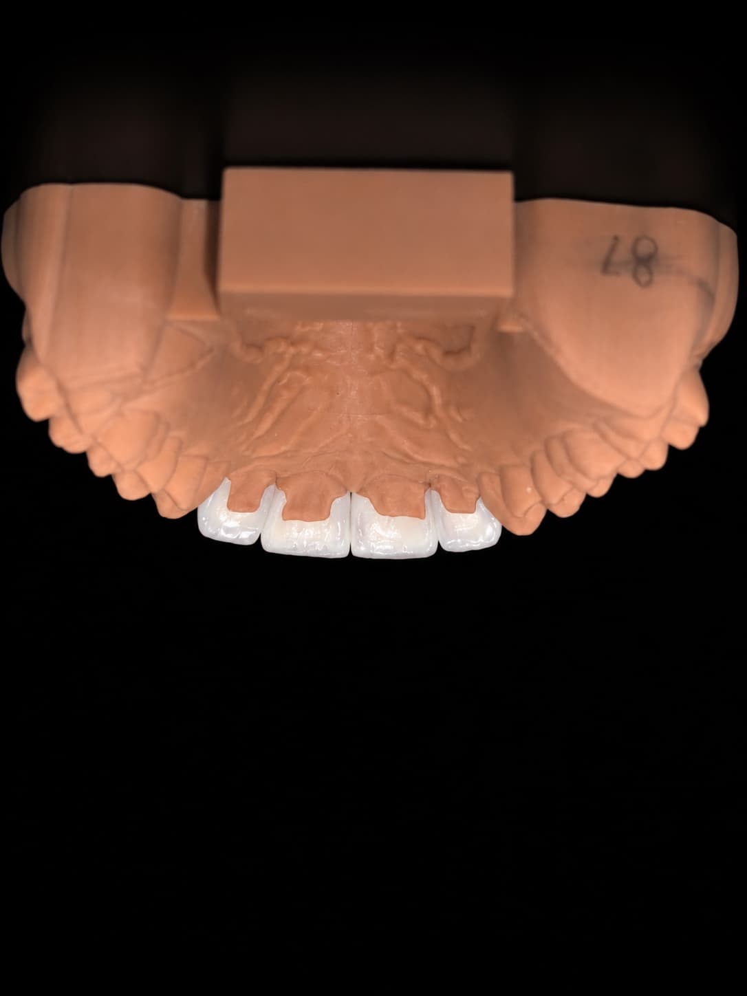 Inside view of Hazel's four veneers seated on the working model
