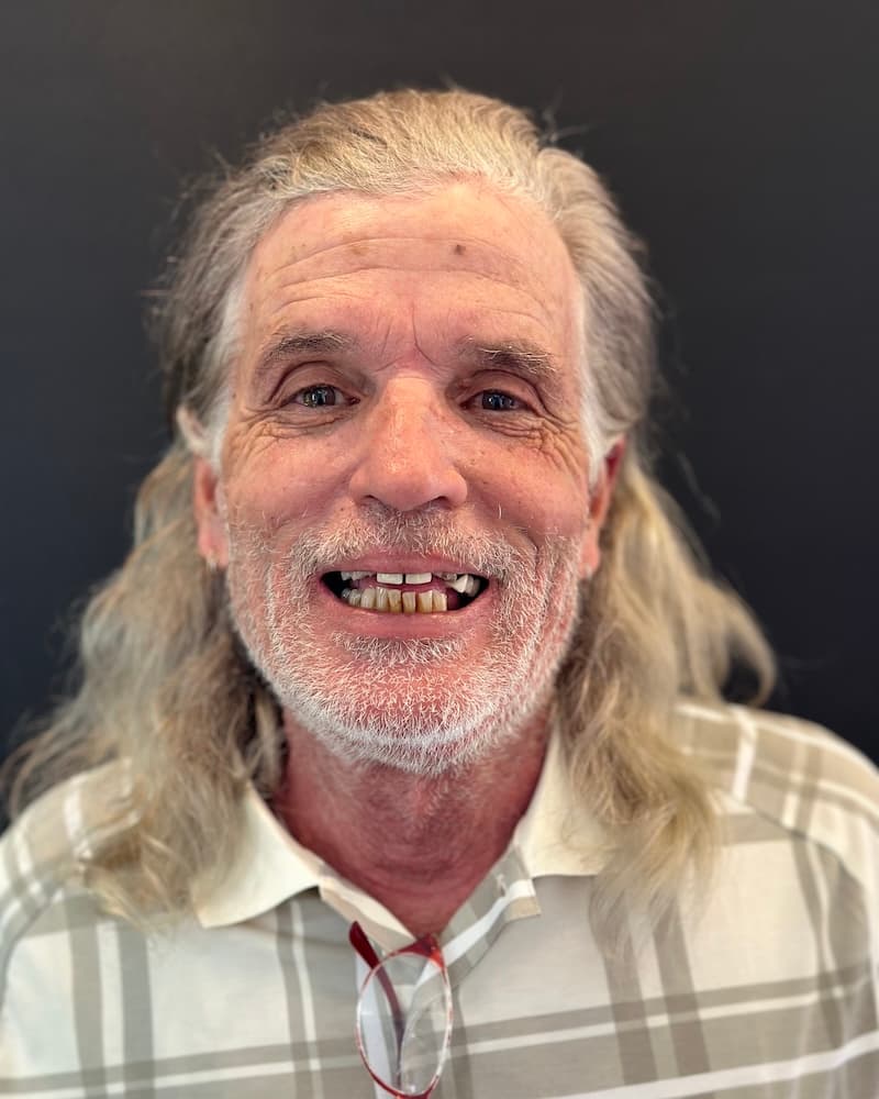 John before full-arch implant treatment at Southern Smiles