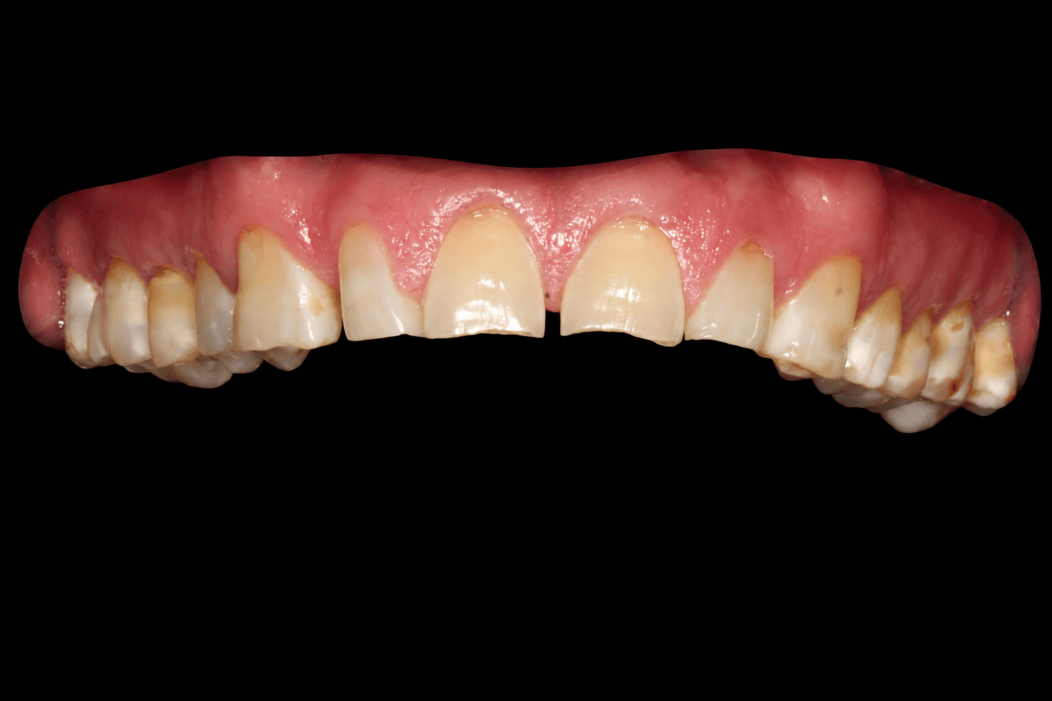 Close-up of Noe's upper teeth before treatment showing wear, spacing, and discoloration