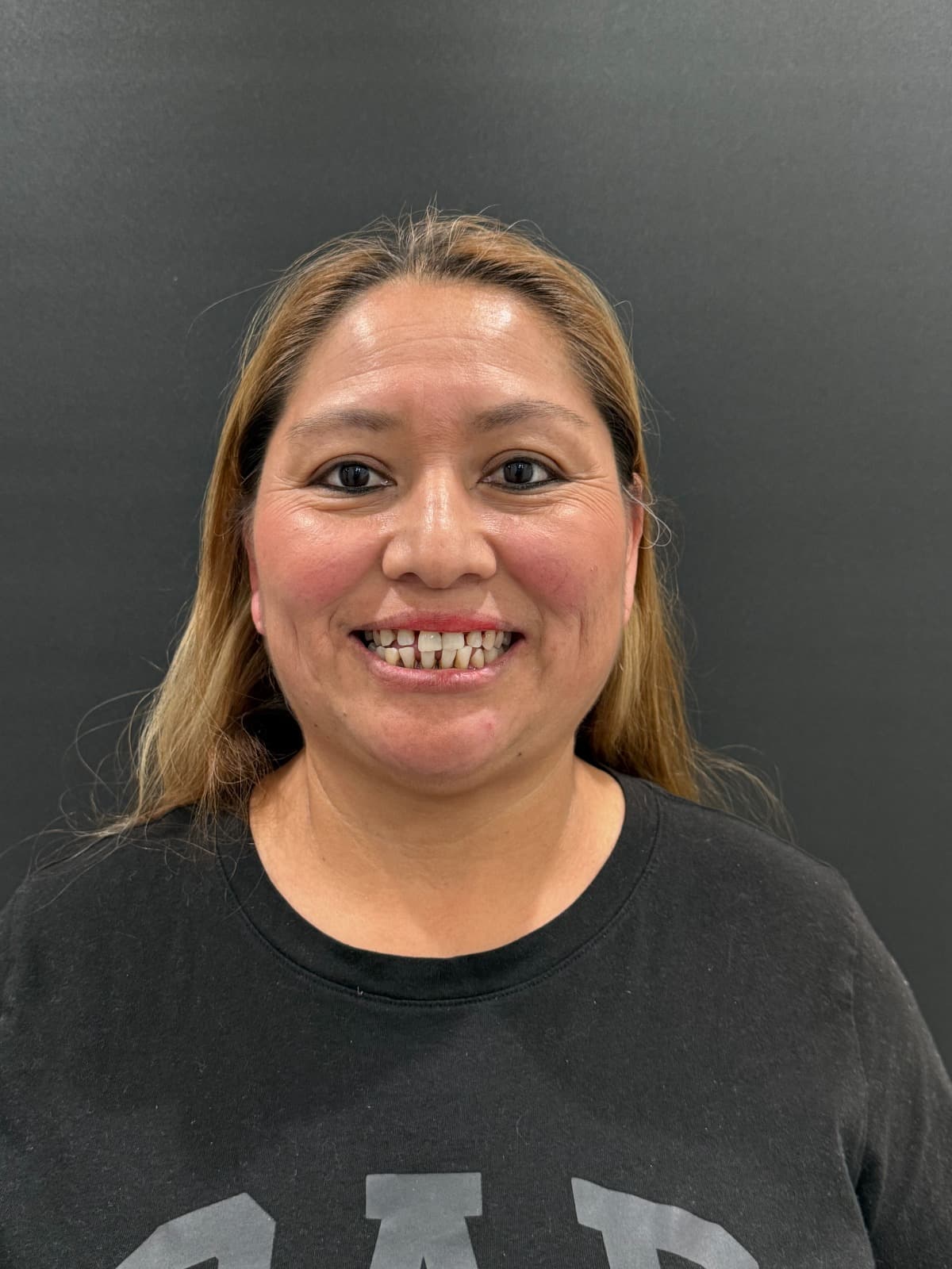 Mirna antes de Dentaduras personalizadas en Southern Smiles