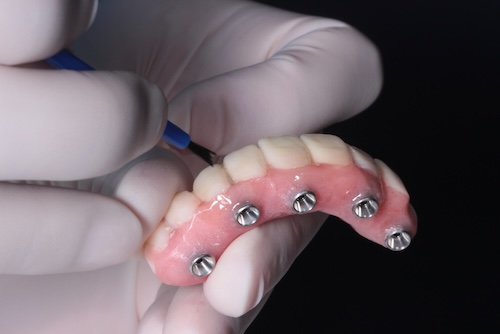Dentures in Phoenix, AZ