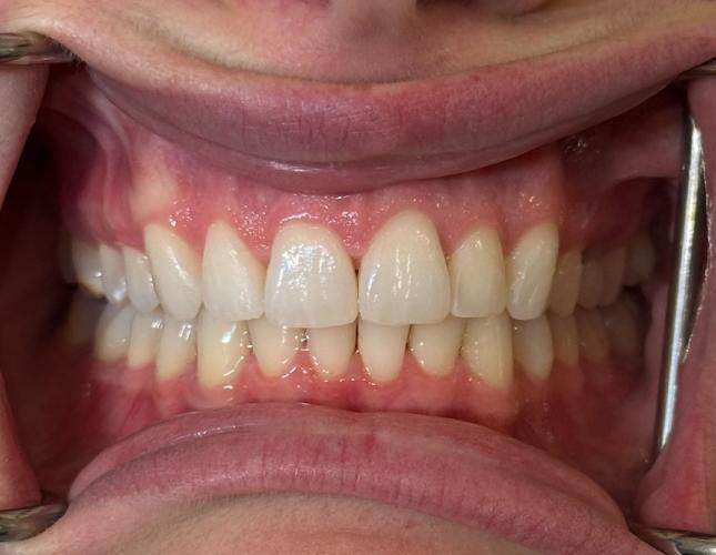 Case 1 after