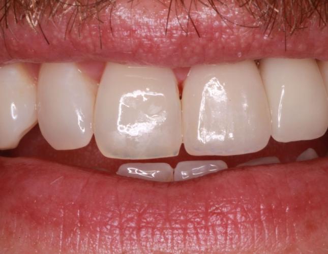 Case 4 after